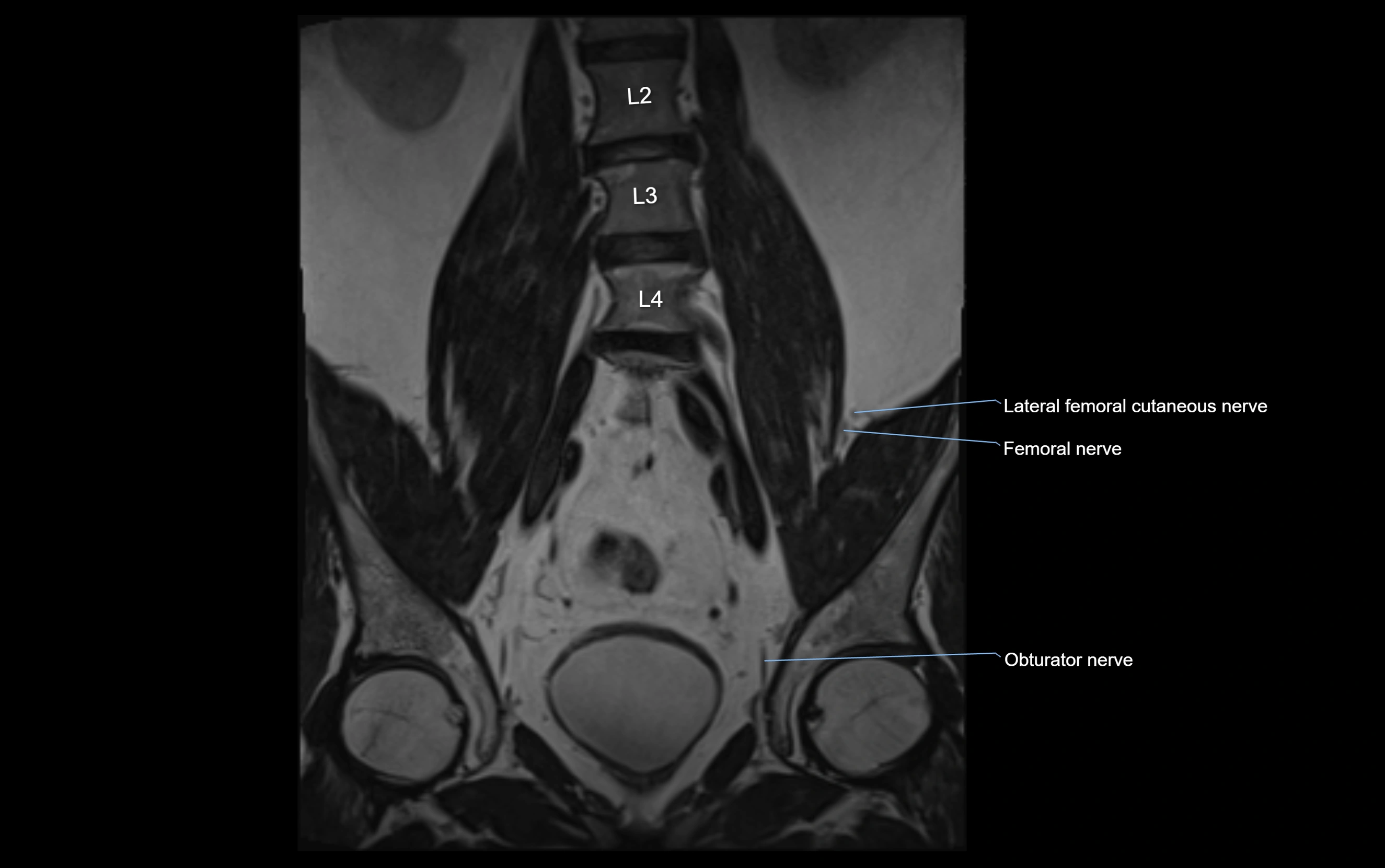 MR lumbosacral plexus cross sectional anatomy 3T  radiology  image-img-09001-00016.webp